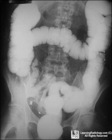 Perforated rectum